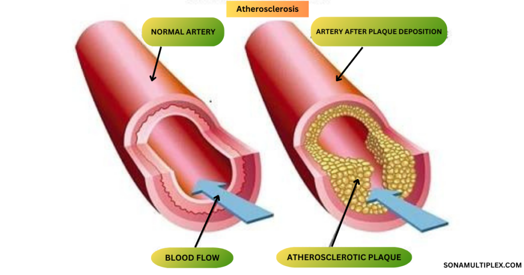 Atherosclerosis Prevention-Power of 10 Foods